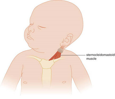 Skrateny krcny sval u novorodenca